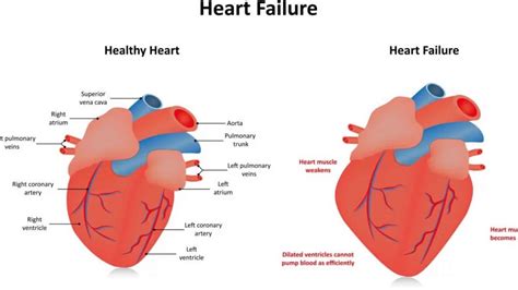 mild global lv hypokinesis|severe global hypokinesis life expectancy.